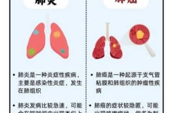 人偏肺病毒感染的原因，偏肺病毒怎么感染的