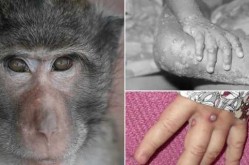 美国现近20年来首例猴痘病毒病例（猴痘病毒是引发猴痘的什么）