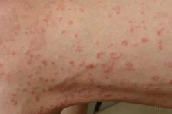 今年感染病毒什么症状，病毒感染全身5种症状
