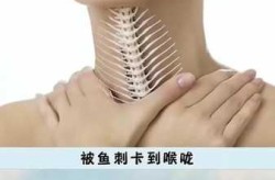 鱼刺卡了喉咙里面怎么办，鱼刺卡在喉咙里不取出来会怎么样
