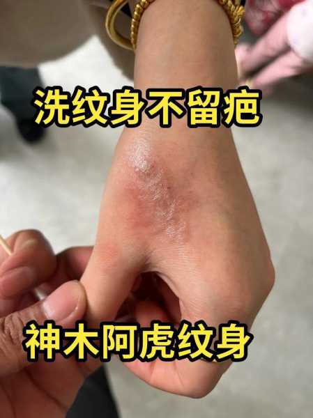 医院纹身洗一般多少钱,洗个小纹身多少钱