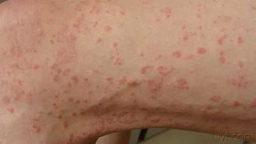 今年感染病毒什么症状，病毒感染全身5种症状