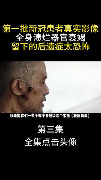二次感染新冠有什么严重后果，新冠二次感染的后遗症有哪些